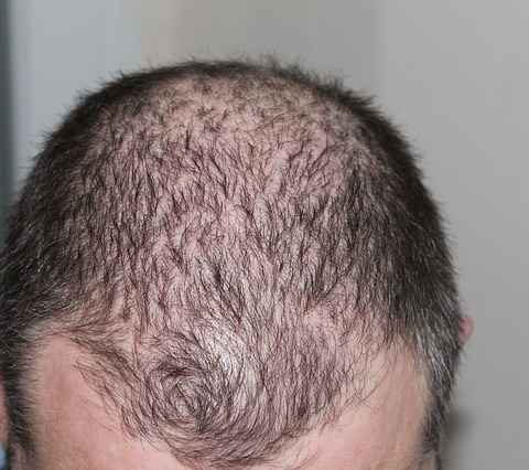 hair fall treatment naturally