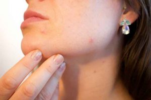 Tips Reduce Acne On Face