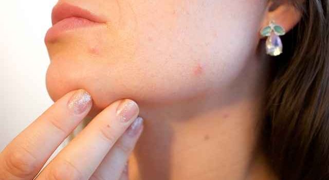 Tips Reduce Acne On Face
