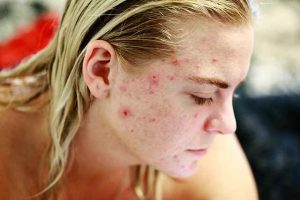 pimples on face removal tips